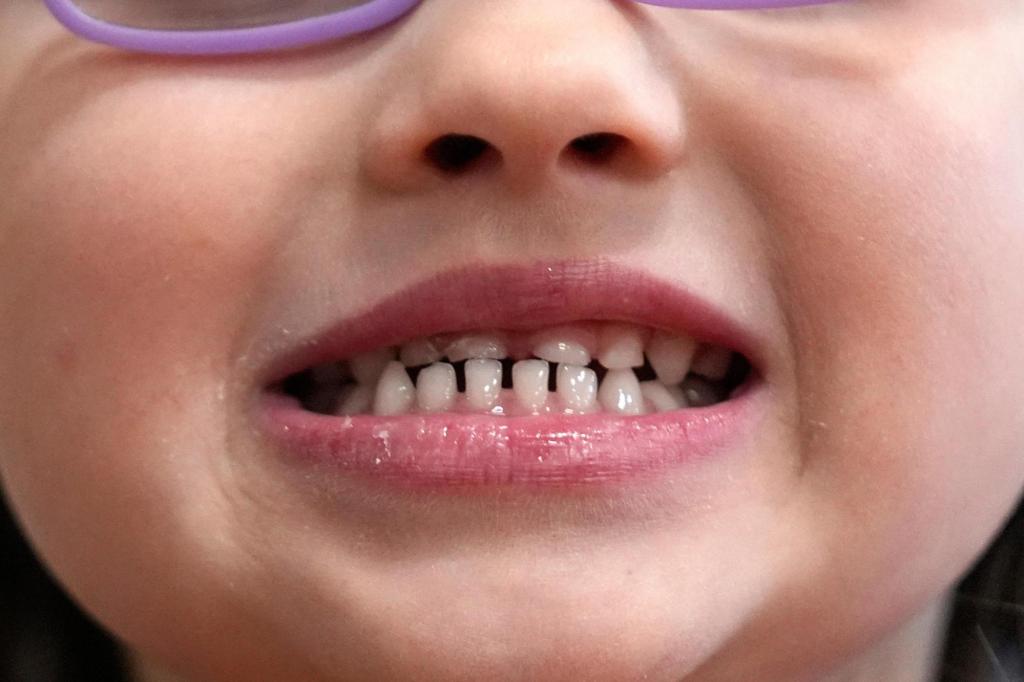 FDA restricts use of kids’ fluoride supplements